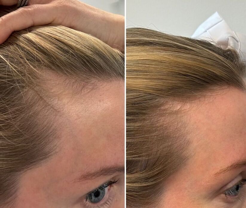 Postpartum hair loss